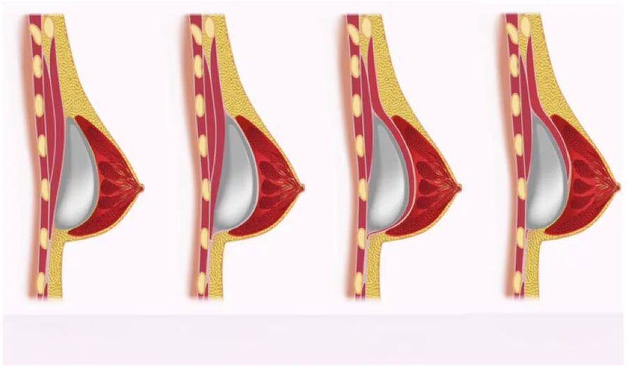 Zougang fir Implantatinstallatioun